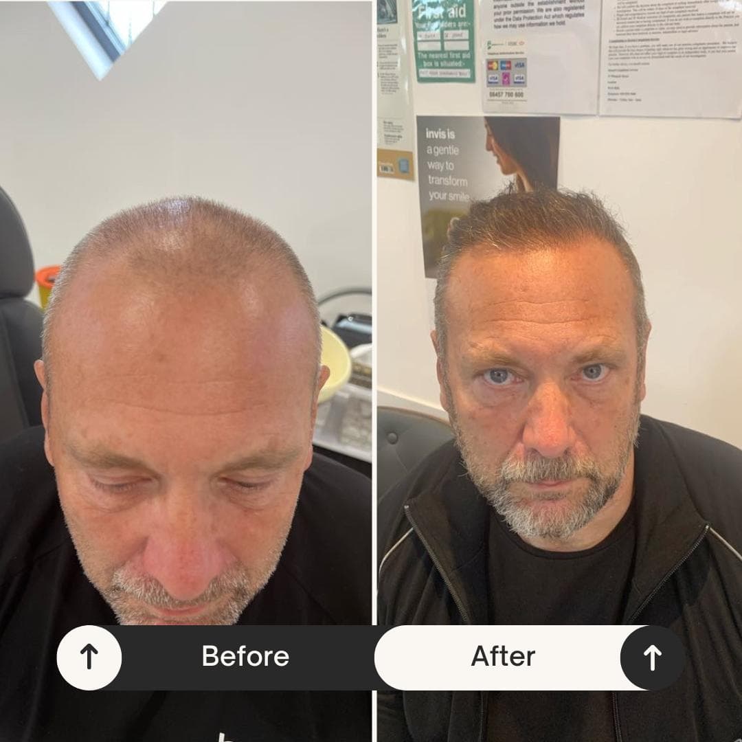 Hair Transplant London Consultation – Speak with Our Experts
