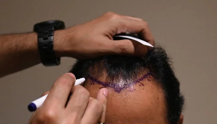 Hair Transplant Turkey: Trusted Specialists for Hair Restoration