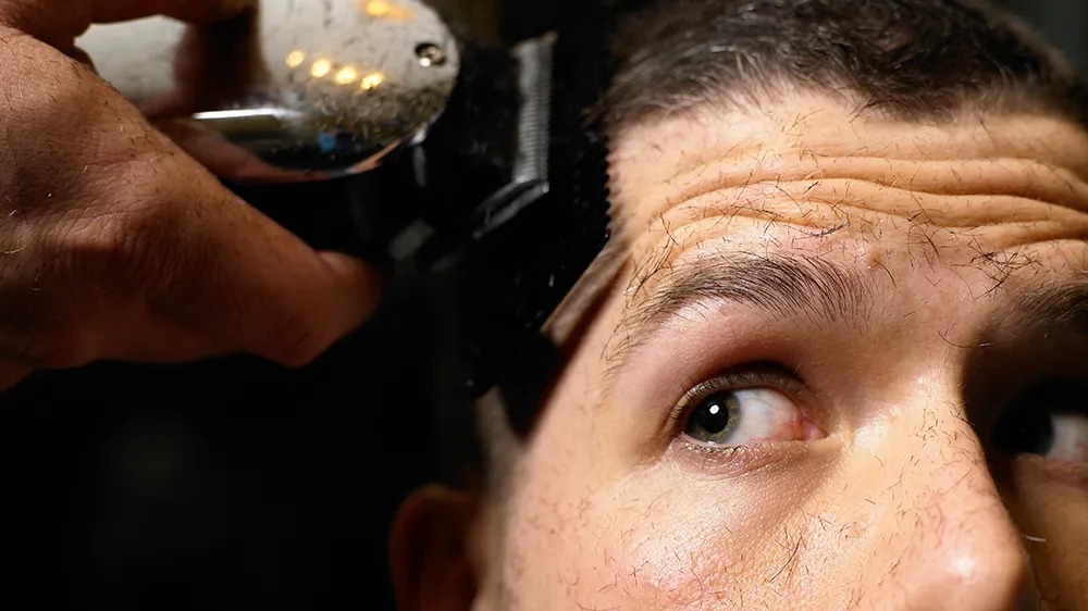 Hair Transplant Turkey – Expert Team, Exceptional Care