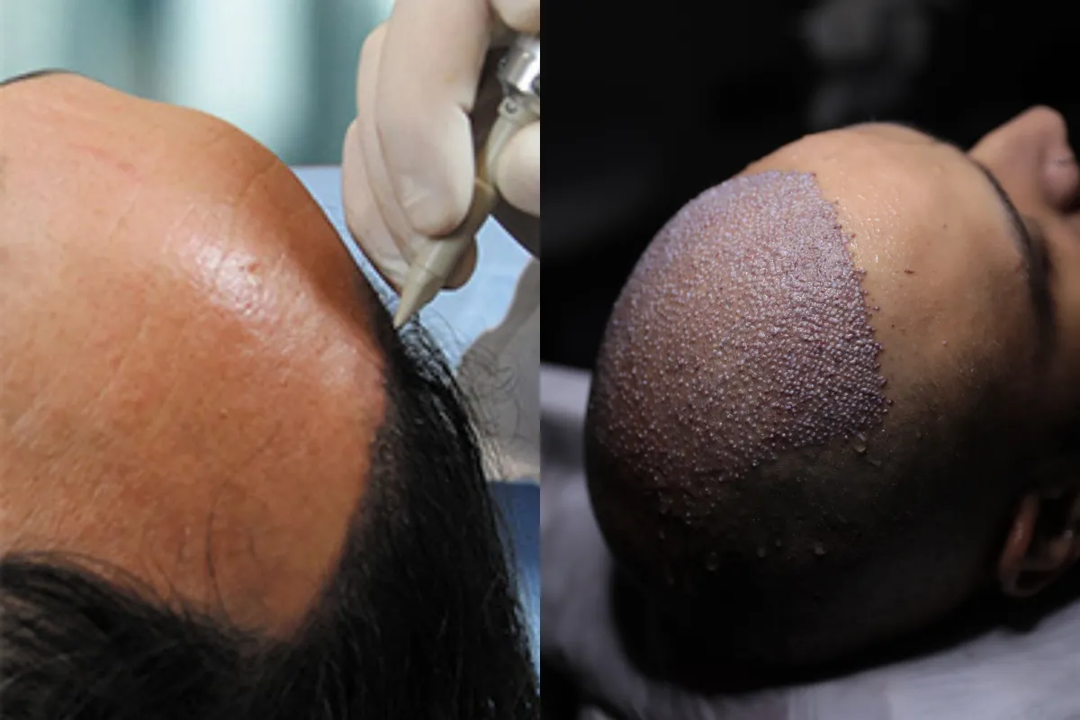 Hair Transplant London Reviews – What Our Clients Say